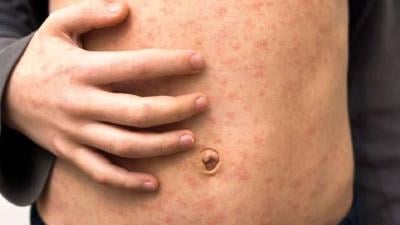 KDHE: First measles case in Kansas since 2018 confirmed