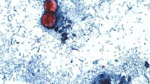 Keene hospital reports additional cyclosporiasis infections
