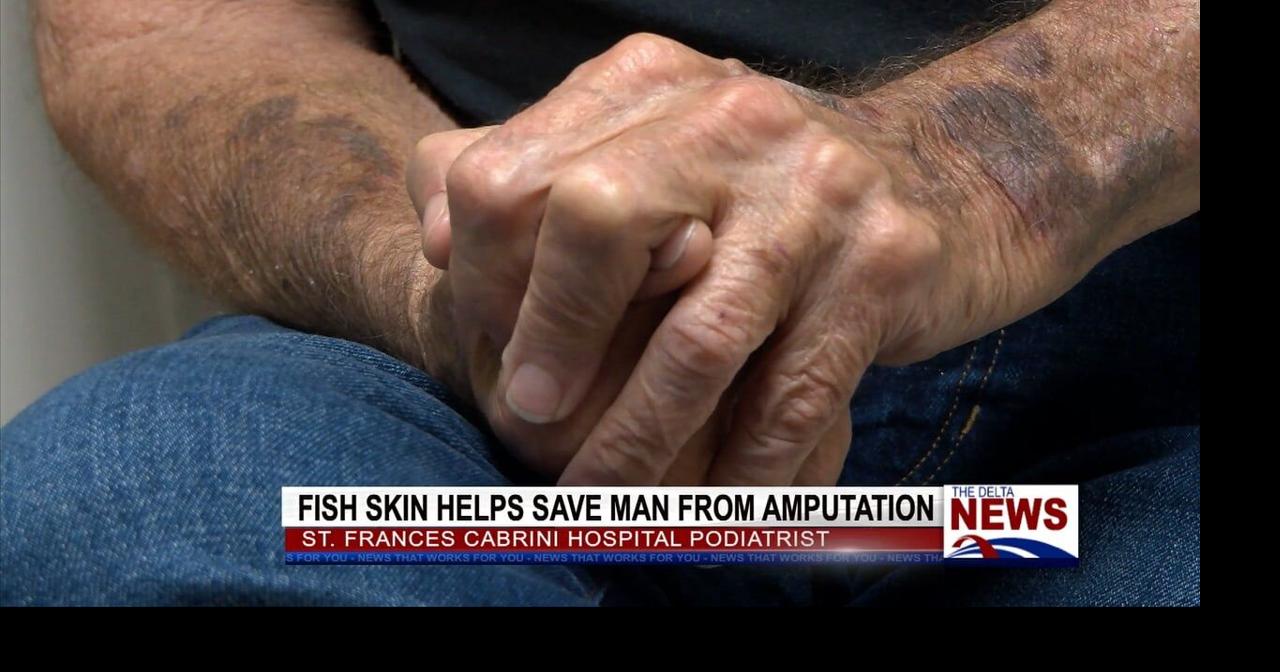 Cod Fish Skin Helps Save Louisiana Man’s Foot from Amputation | News ...