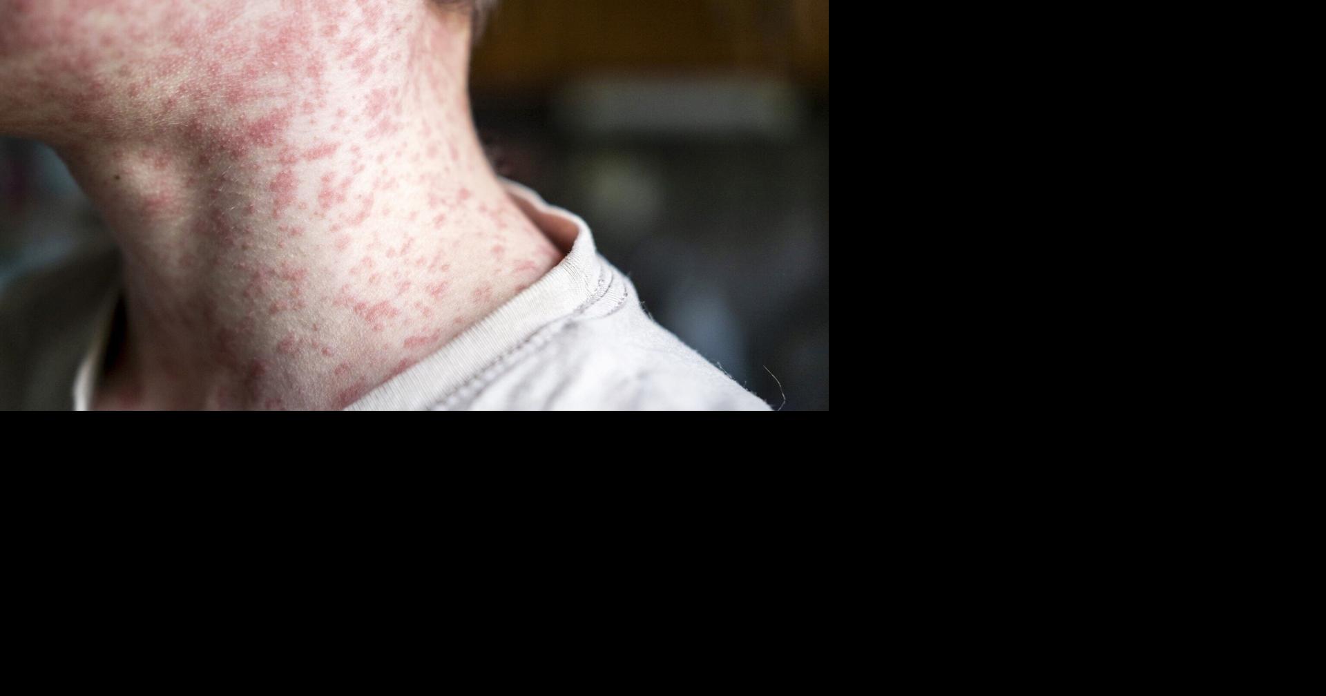 Measles cases confirmed at N.O. airport; health expert points to immunization decrease
