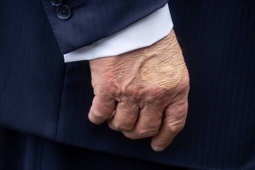 Trump diagnosed with chronic venous insufficiency following leg swelling |  Politics | kten.com