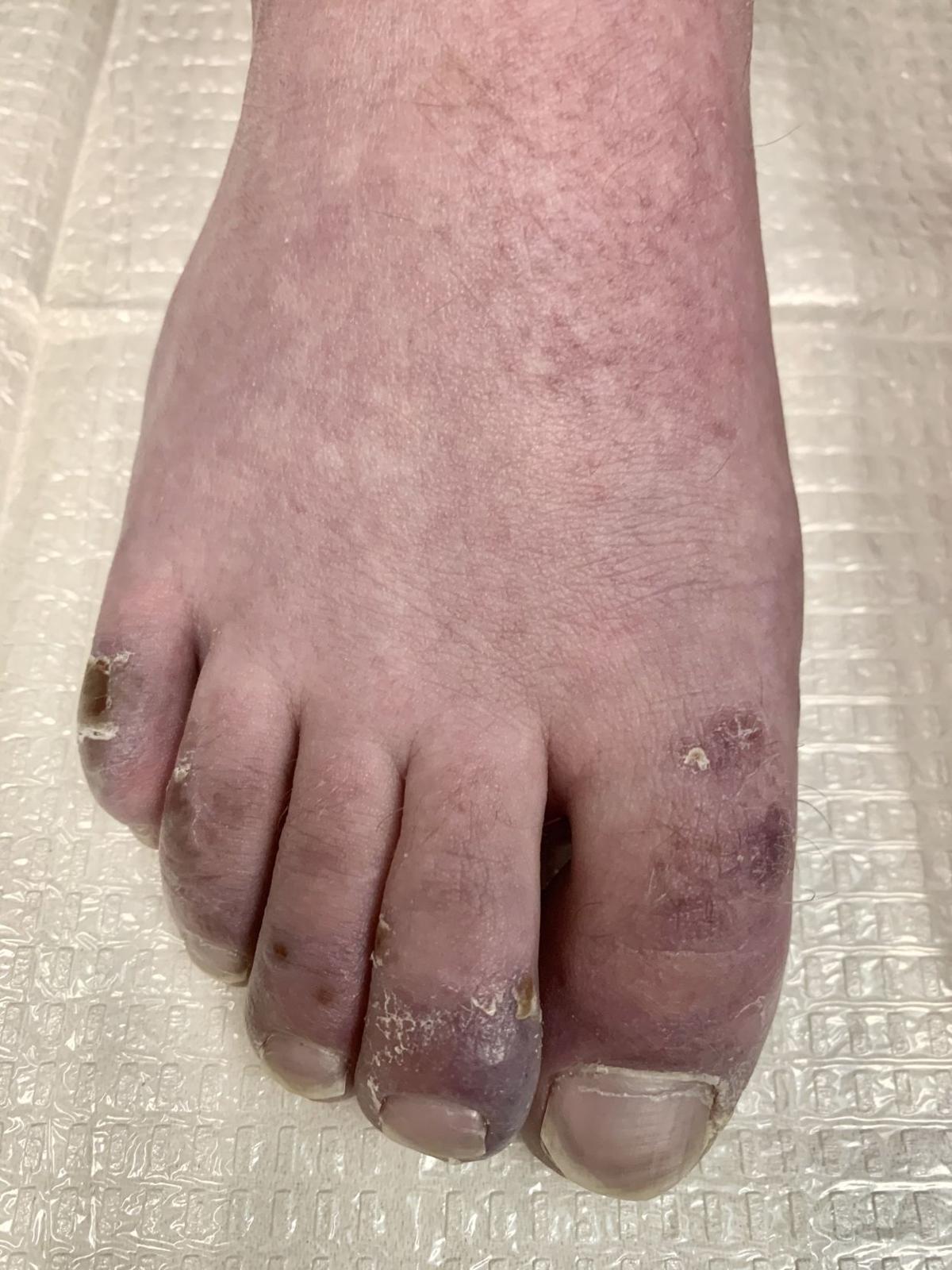 Uw Studying Covid Toes Skin Condition Apparently Linked To Covid 19 State And Regional Lacrossetribune Com