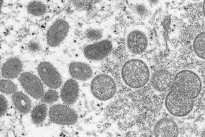 CDC identifies 9 monkeypox cases in 7 states