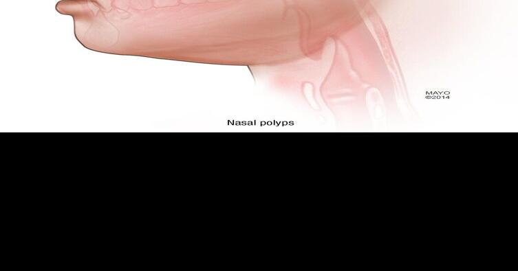 Don’t let nasal polyps steal your scent-sibility