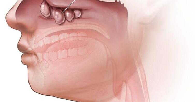 Don’t let nasal polyps steal your scent-sibility Don’t let nasal polyps steal your scent-sibility