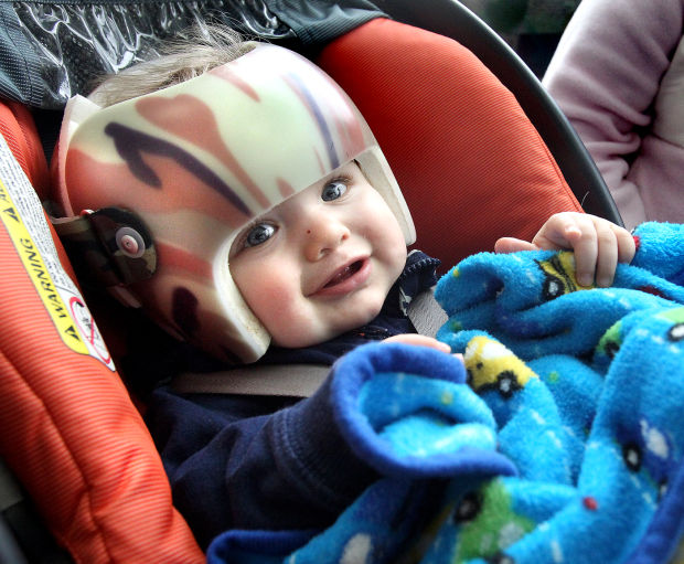 3D scanner takes trauma out of casting helmets for kids' misshapen