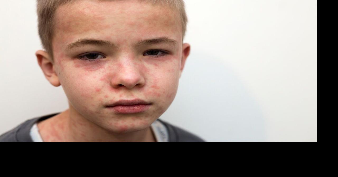 Measles in LA County: Third case confirmed, all travel-related