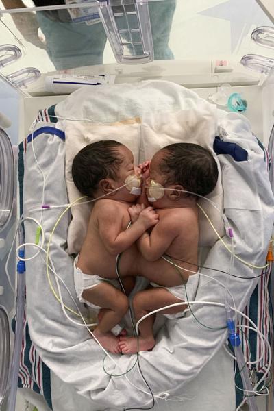 Conjoined Twins Separated