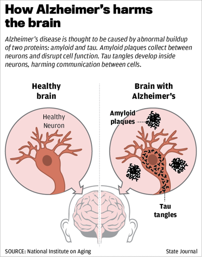 How Alzheimer's  harms the brain