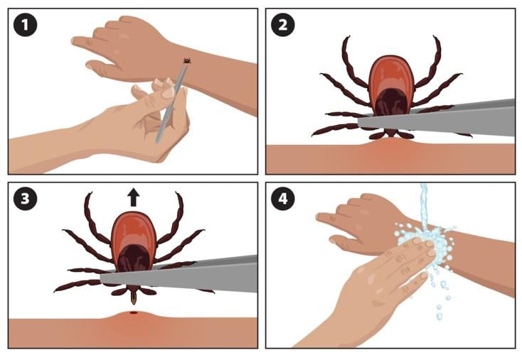 CDC steps for removing a tick