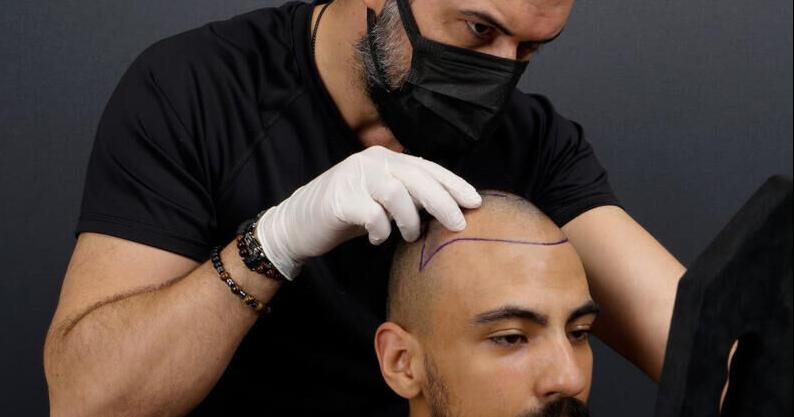 Hair transplant in Turkey: What makes it a top choice? - Vimarsana News