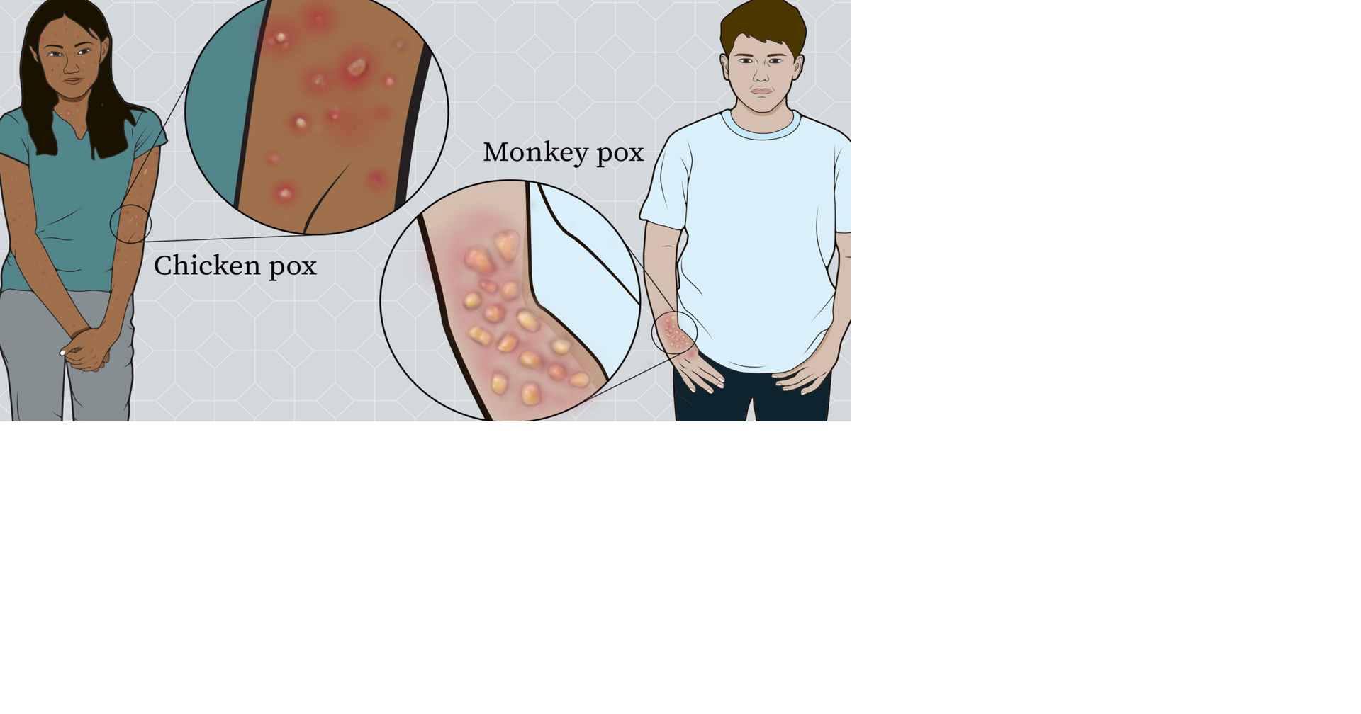 Mpox Is Not Chickenpox: Here’s the Difference | News | liberianobserver.com