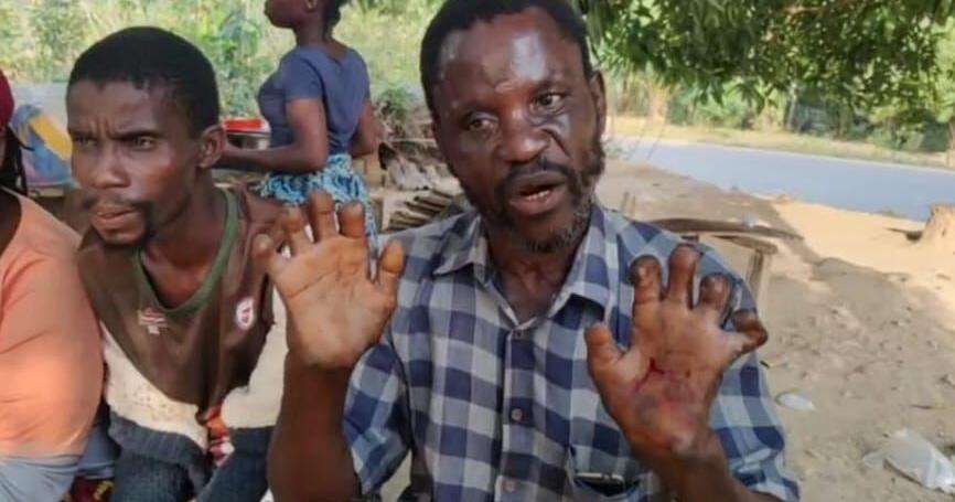 Gbarnga Central Prison Rejects Leprosy &ldquo;Detainees&rdquo;