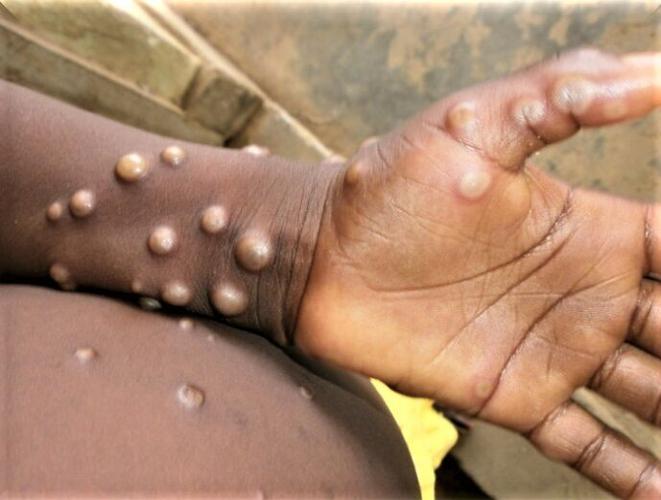 Monkeypox rash 01.jpg