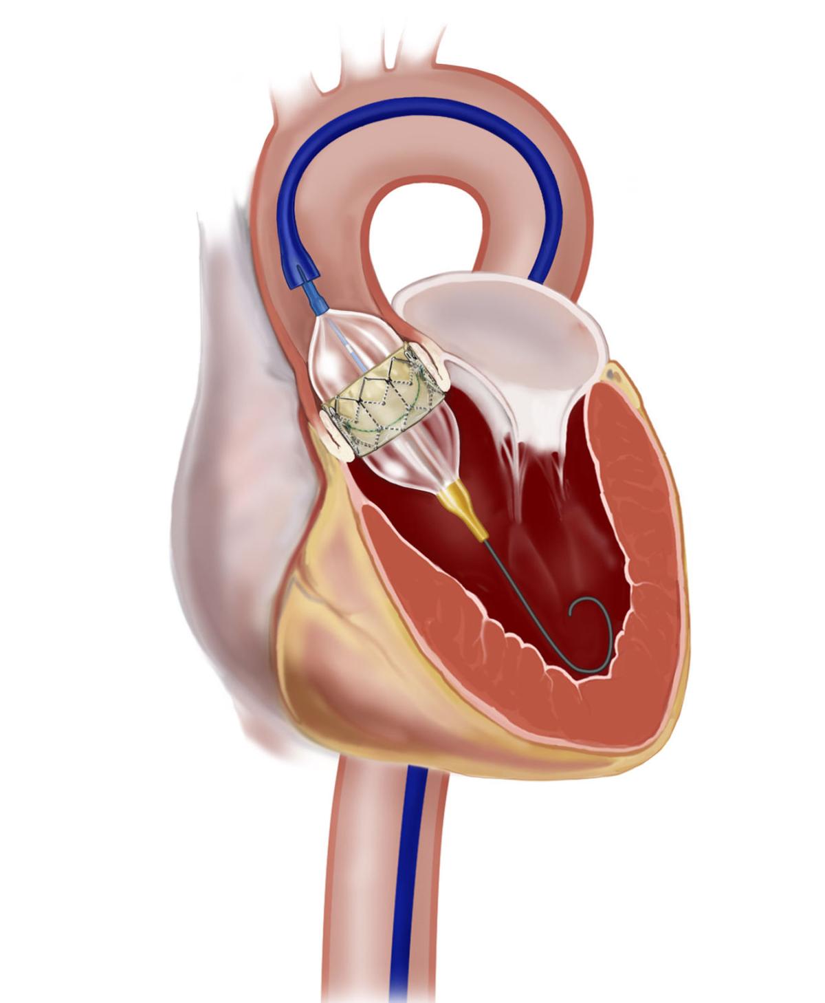 Doctors detail procedure repairing crucial heart valve Community
