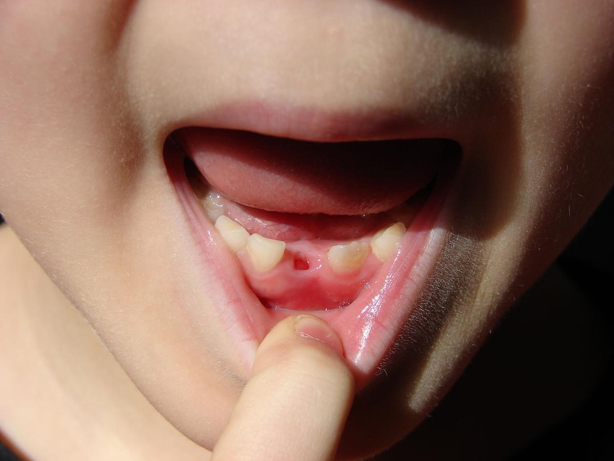 Blue Sky Science How And Why Do Our Teeth Fall Out Blue Sky Science Madison Com