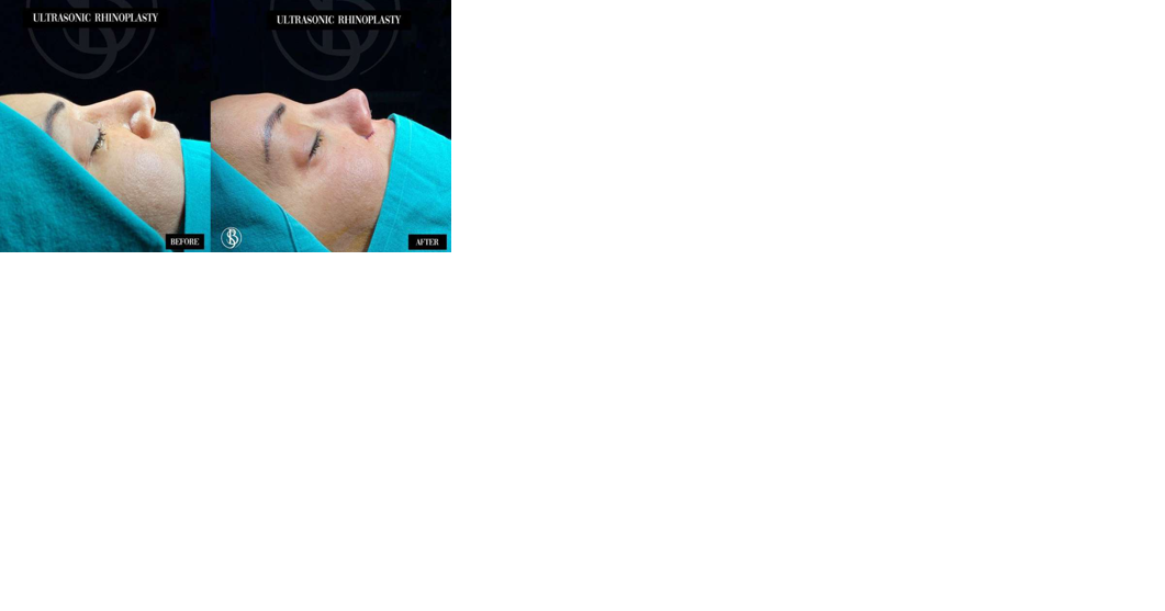 Top 10 best rhinoplasty (nose job) doctors In Turkey 2024 - Vimarsana News