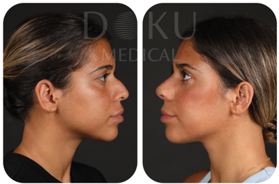 rhinoplastyimage1