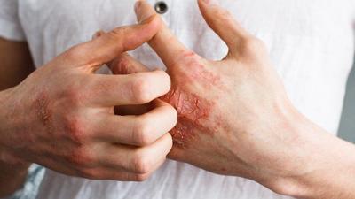 Dry, Cracked Hands That Won’t Go Away? 5 Things to Know About Chronic ...
