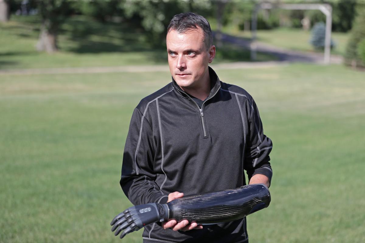 Ben showing prosthesis