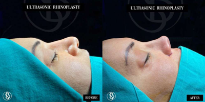 rhinoplastyimage1