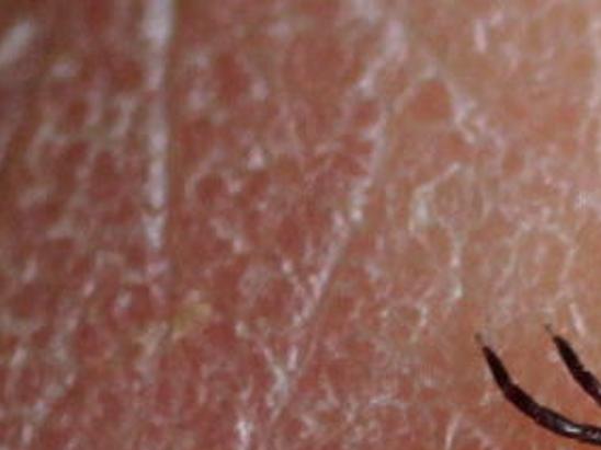 Ask The Weather Guys Is Lyme Disease Connected To The Weather Weather Madison Com