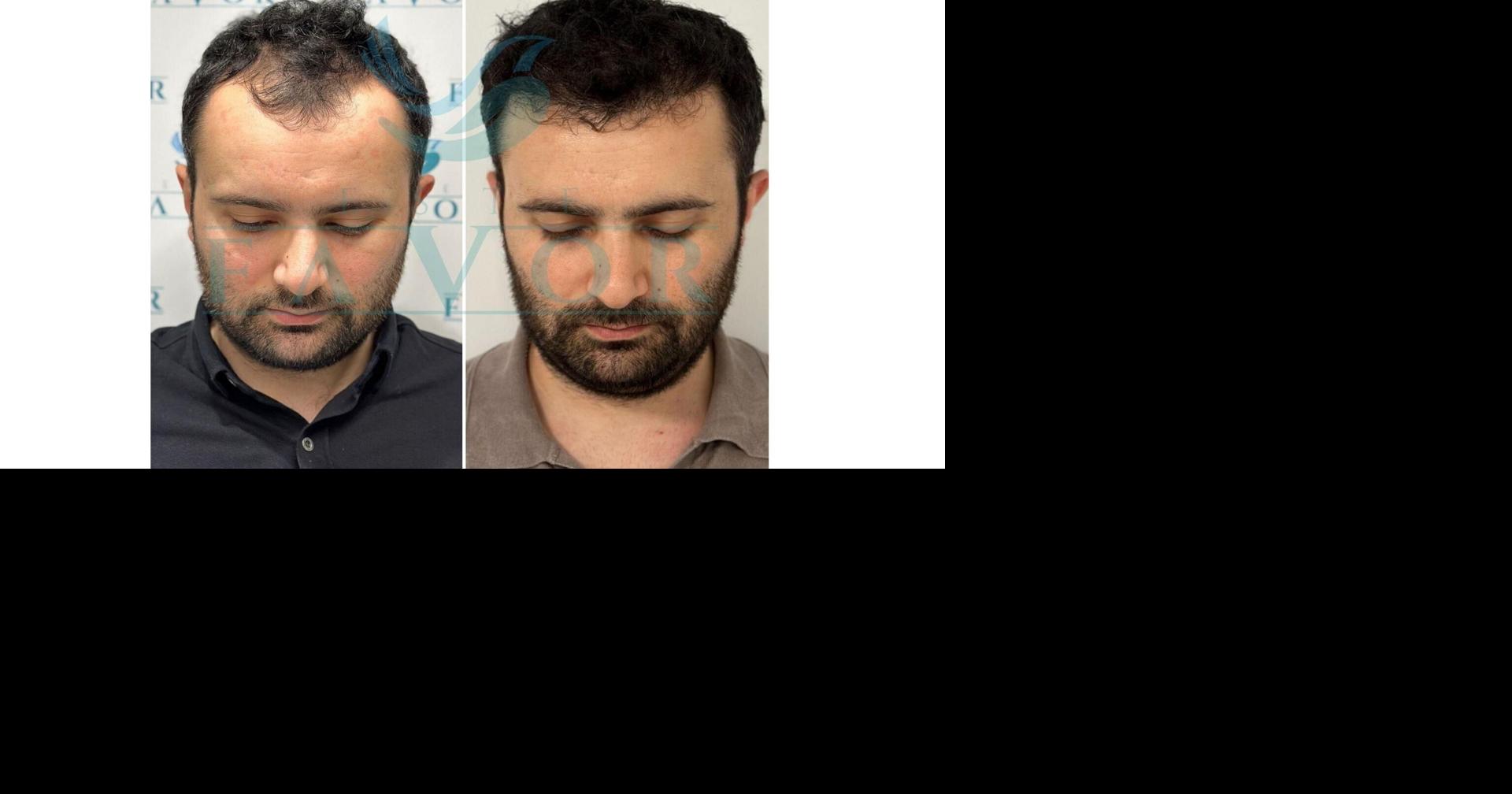 Top 10 Best Hair Transplant Clinics in Turkey (2026): The American and Canadian Patient's Complete Price Guide