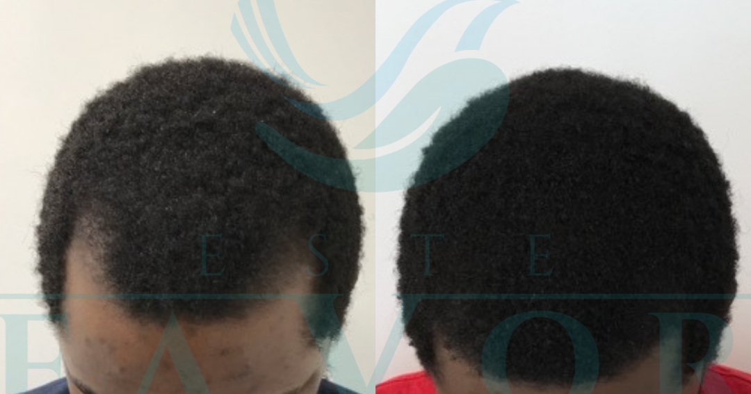 Best Afro hair transplant clinics in Turkey and Afro hair transplant prices 2024 - Vimarsana News
