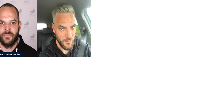 Best hair transplant Istanbul – Smile Hair Clinic - Vimarsana News