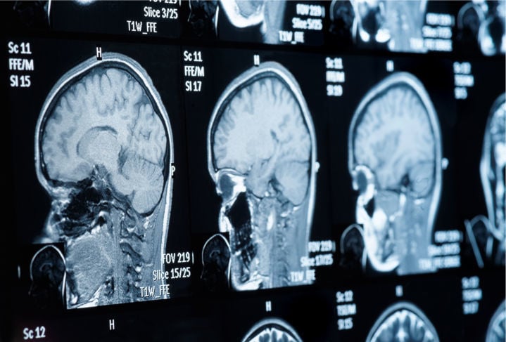 MRI scan