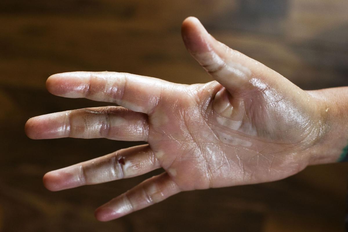 'Almost Exploding' Recalled Sparklers Burn Several in Twin on July 4