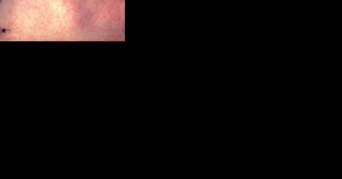 Public health investigating measles exposure at MacKids - Vimarsana News