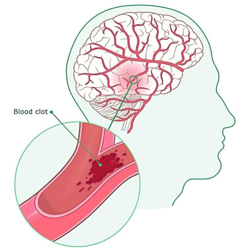 Health: TIA - A warning sign
