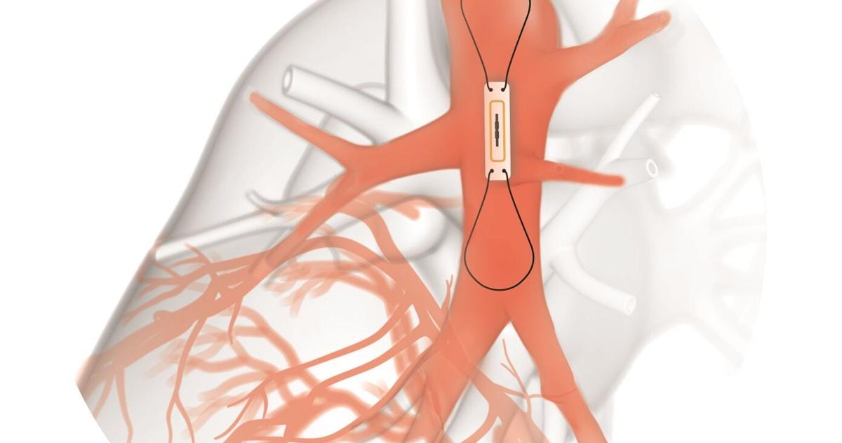 CVMC now offering innovative procedure for heart failure management