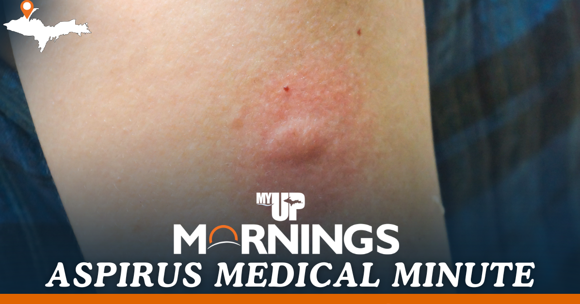 Aspirus Medical Minute: Protecting yourself from tick and insect bites and illnesses