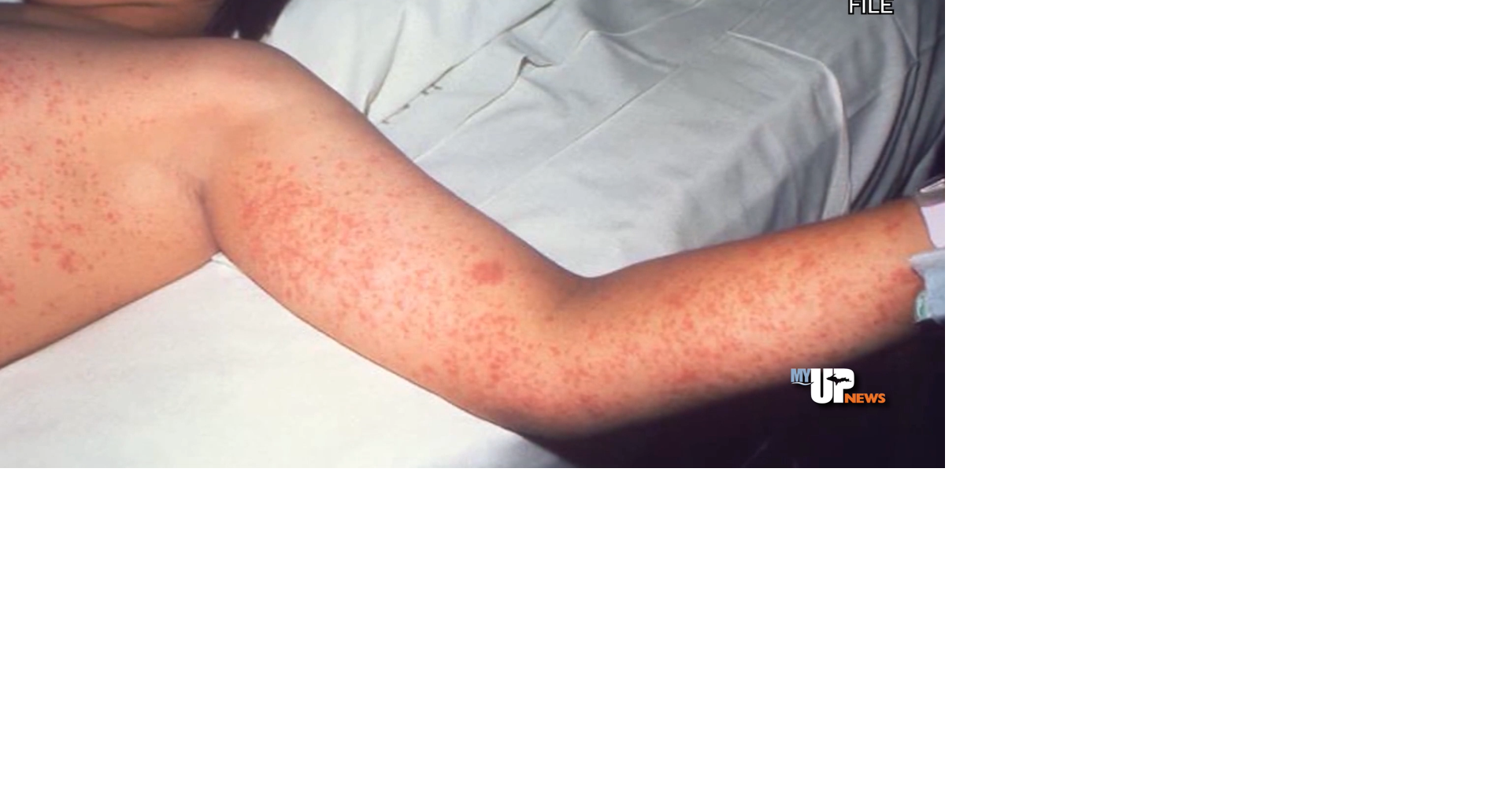 Health departments says measles outbreak rumors in Delta and Menominee Counties are false