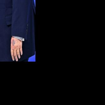 Fresh bruising could be seen on the back of US President Donald Trump's left hand during an event in Davos, Switzerland