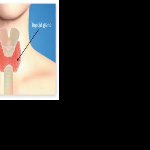 Got a goiter?
