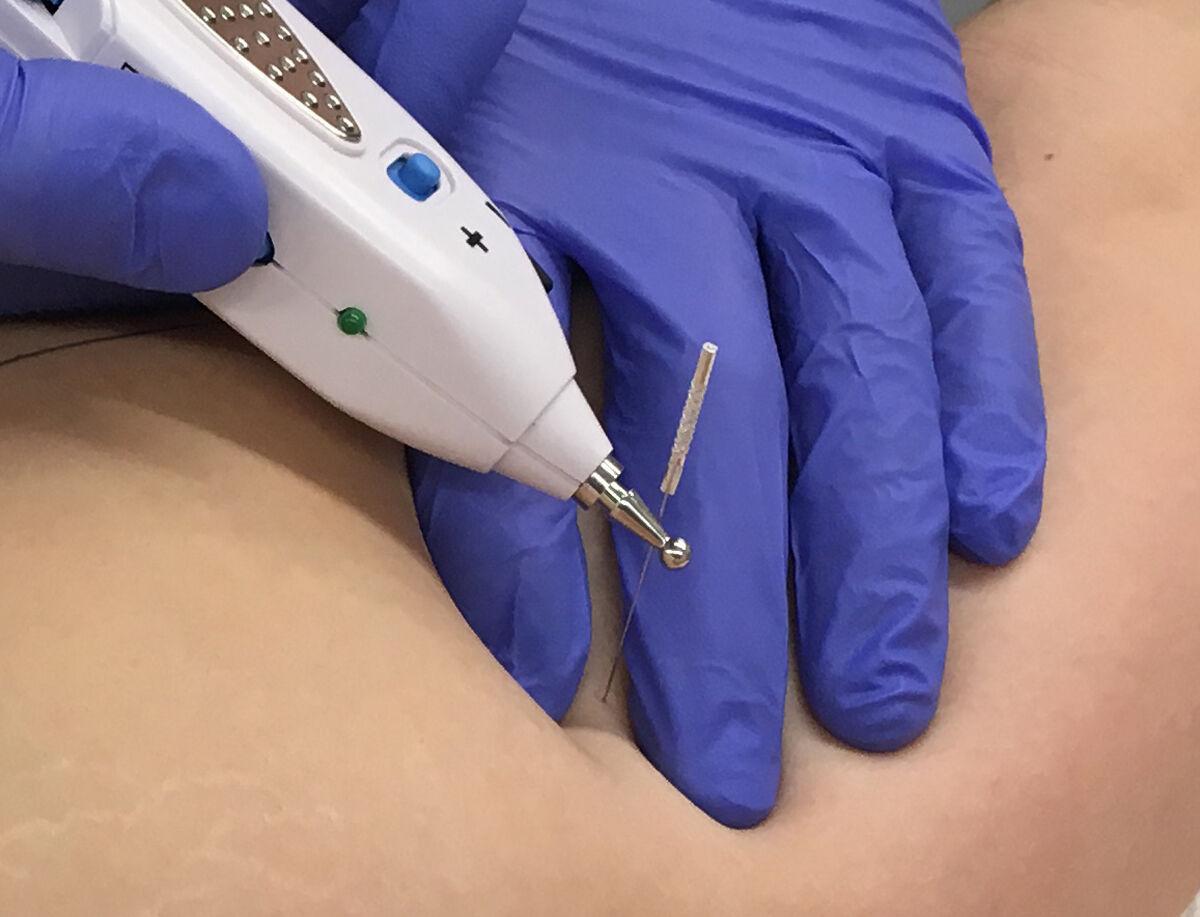 How Effective Is Physical Therapy Dry Needling With Electrical Stimulation?  - Mend Colorado