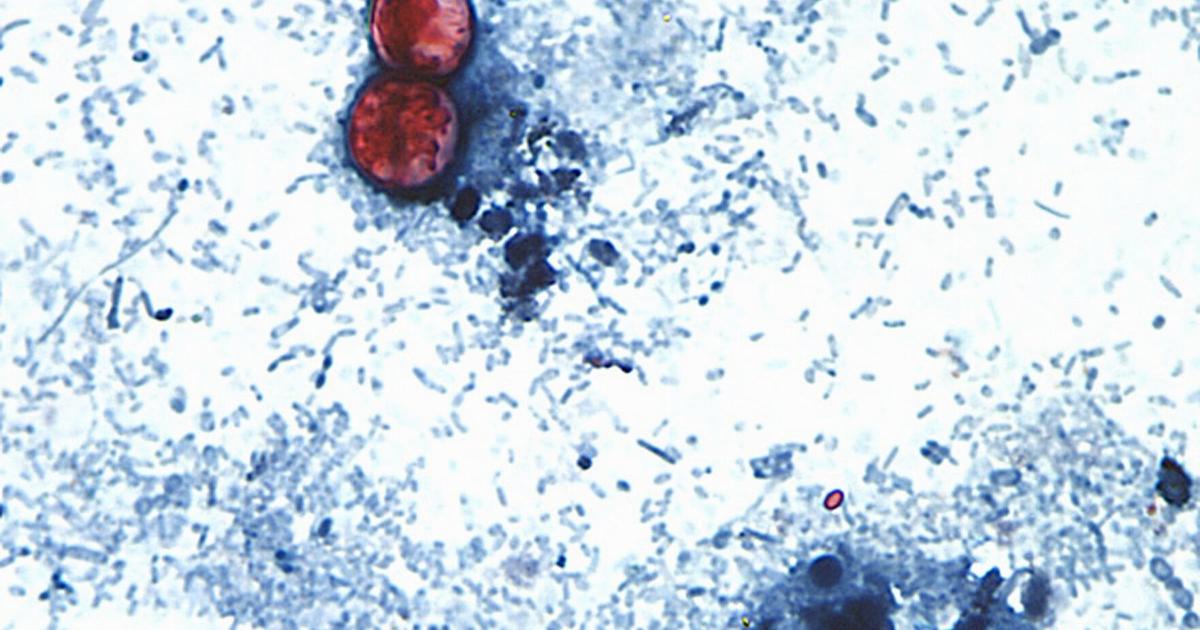 Cases of cyclosporiasis in Oklahoma increase | News | normantranscript.com