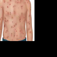 Outbreak of chicken pox investigated in Henry County - Vimarsana News