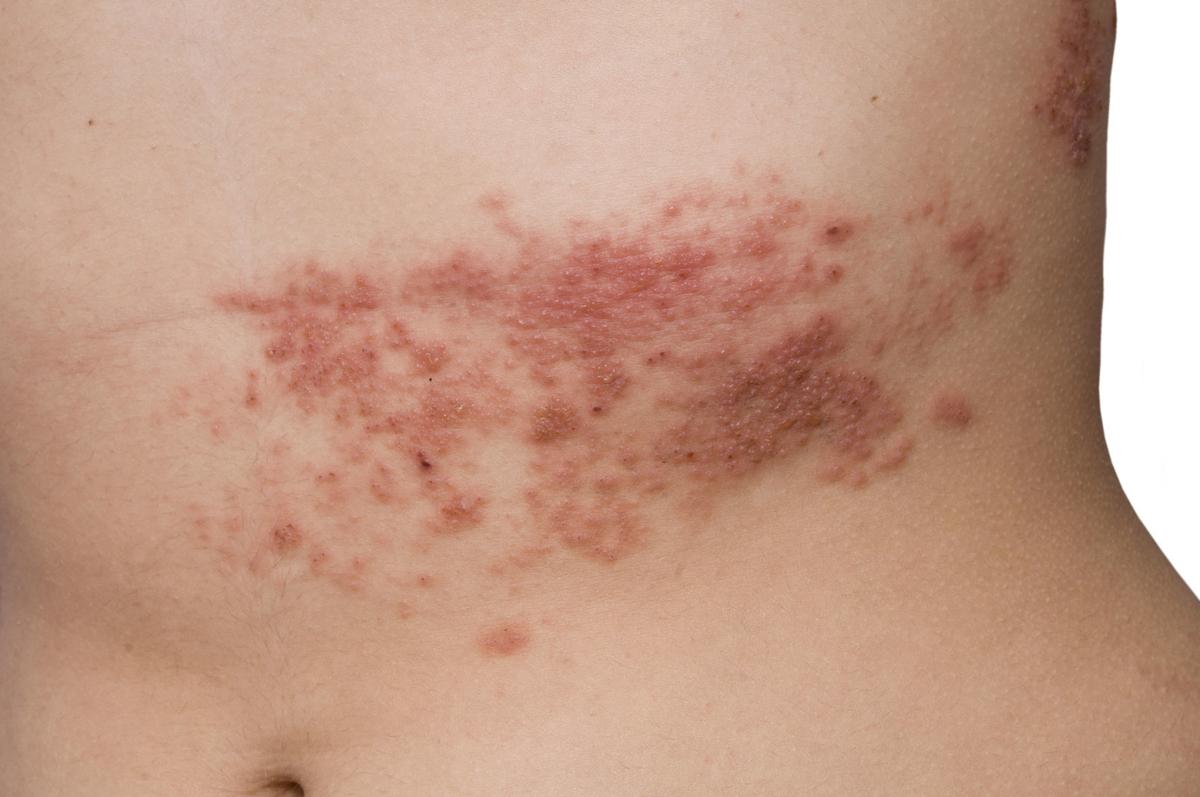 If You Ve Had Chickenpox You Can Get Shingles Here S How To