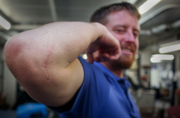 With Tommy John surgery, every scar tells a story