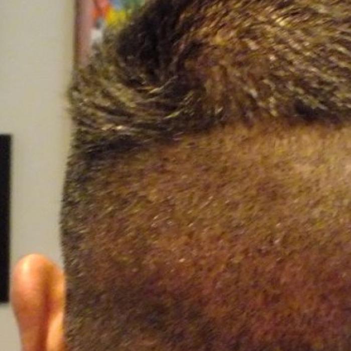 New Hair Transplant Robot Decreases Downtime Increases Patients Self Esteem Get Healthy Nwitimes Com