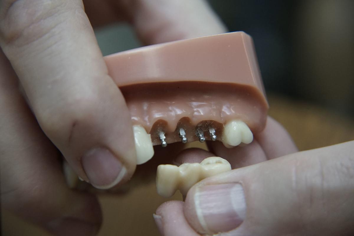 Options To Deal With Missing Teeth Span Traditional Dentures To An Array Of Implants Health Care Nwitimes Com