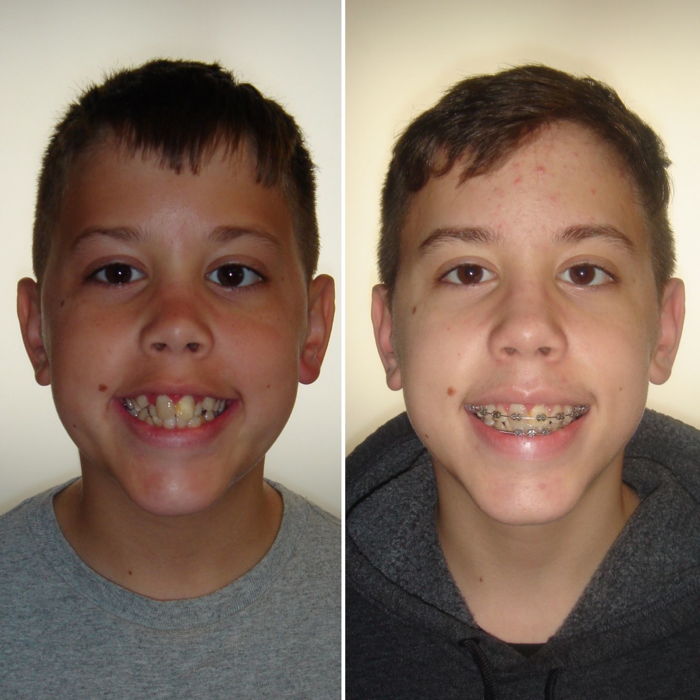 teeth straightening treatment