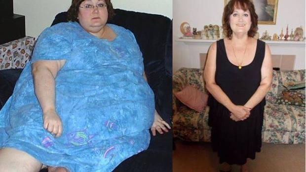 weight surgery loss without pounds 230 nwitimes