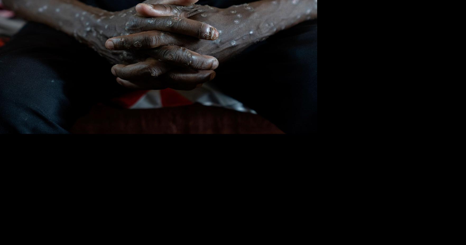 Congo says its mpox outbreak is over after 2 years and more than 2,200 suspected deaths