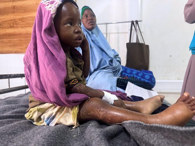 Somalia Malnutrition Crisis: Mother Walks Three Days Carrying Sick Daughter to Hospital