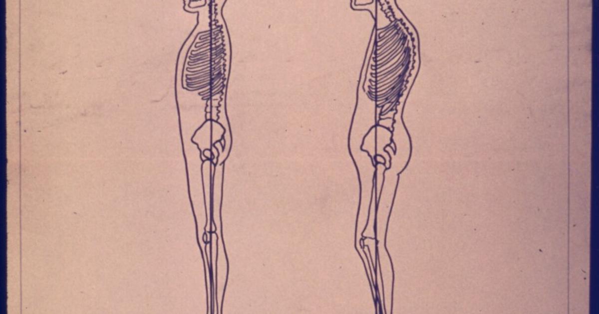 Skeleton Slouched Top 4 reasons you should stop slouching